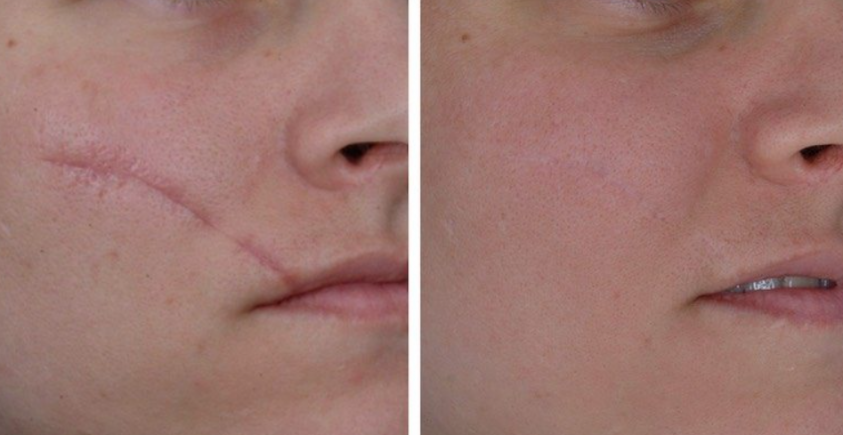 scar removal treatment