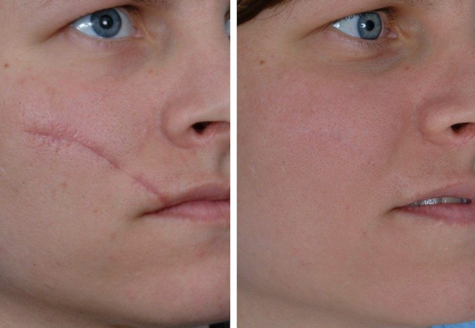 scar removal treatment